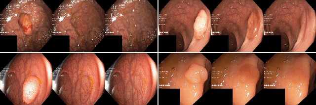 Figure 4 for Polyp-E: Benchmarking the Robustness of Deep Segmentation Models via Polyp Editing