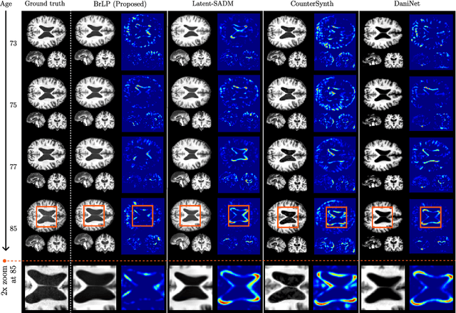Figure 3 for Enhancing Spatiotemporal Disease Progression Models via Latent Diffusion and Prior Knowledge