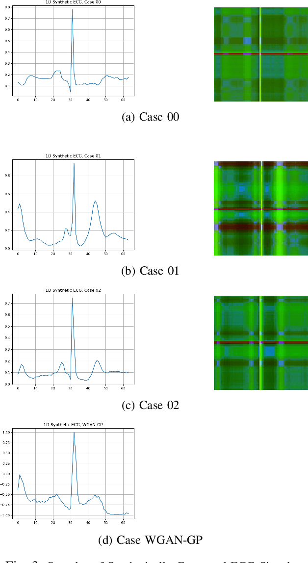 Figure 3 for Synthetic ECG Signal Generation using Probabilistic Diffusion Models