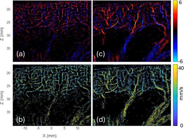 Figure 2 for Optimizing In Vivo Data Acquisition for Robust Clinical Microvascular Imaging Using Ultrasound Localization Microscopy