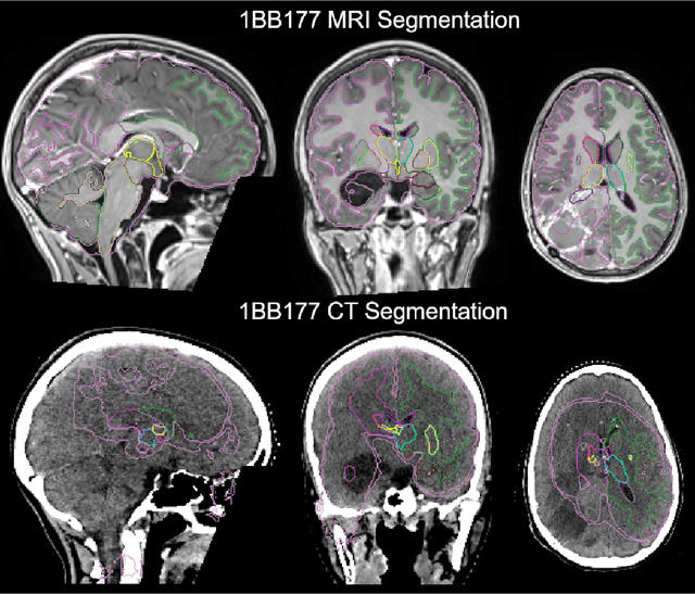 Figure 4 for Deep learning-based brain segmentation model performance validation with clinical radiotherapy CT