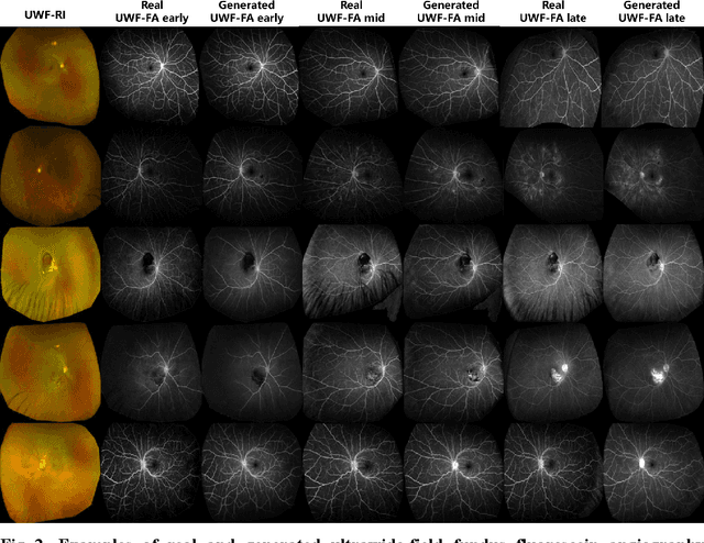 Figure 2 for UWF-RI2FA: Generating Multi-frame Ultrawide-field Fluorescein Angiography from Ultrawide-field Retinal Imaging Improves Diabetic Retinopathy Stratification