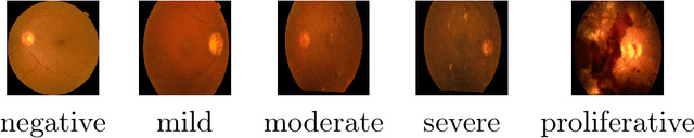 Figure 1 for Detecting Severity of Diabetic Retinopathy from Fundus Images using Ensembled Transformers