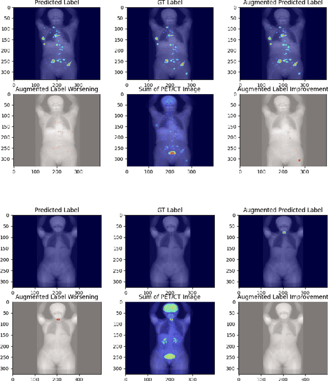 Figure 4 for AutoPET Challenge: Tumour Synthesis for Data Augmentation