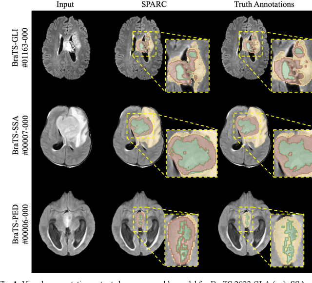 Figure 2 for Ensemble Learning and 3D Pix2Pix for Comprehensive Brain Tumor Analysis in Multimodal MRI