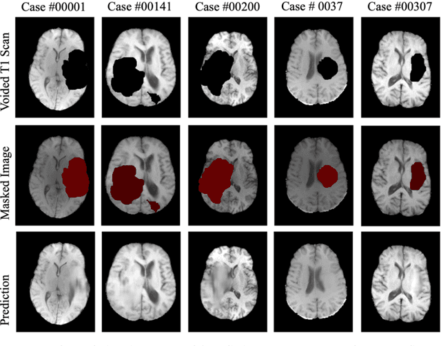 Figure 4 for Ensemble Learning and 3D Pix2Pix for Comprehensive Brain Tumor Analysis in Multimodal MRI