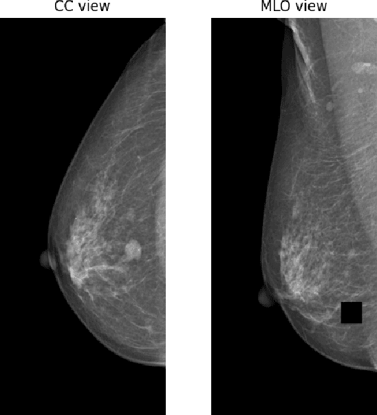 Figure 3 for TransReg: Cross-transformer as auto-registration module for multi-view mammogram mass detection