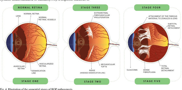 Figure 4 for Current and future roles of artificial intelligence in retinopathy of prematurity