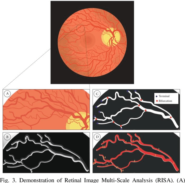 Figure 3 for Current and future roles of artificial intelligence in retinopathy of prematurity