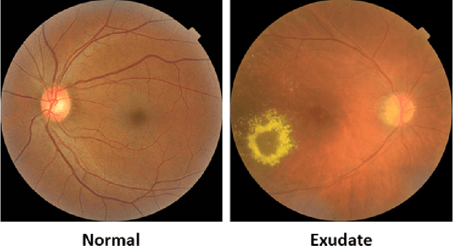 Figure 1 for Enhancing Diabetic Retinopathy Diagnosis: A Lightweight CNN Architecture for Efficient Exudate Detection in Retinal Fundus Images