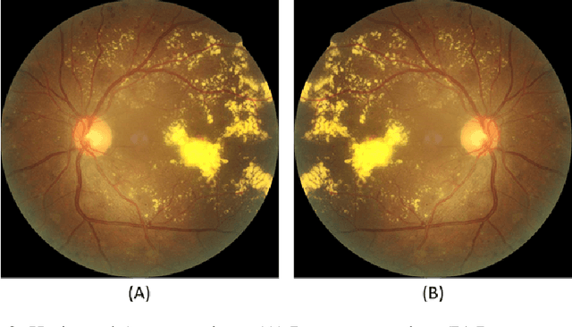 Figure 4 for Enhancing Diabetic Retinopathy Diagnosis: A Lightweight CNN Architecture for Efficient Exudate Detection in Retinal Fundus Images