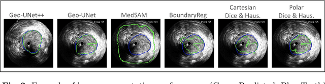 Figure 3 for Geo-UNet: A Geometrically Constrained Neural Framework for Clinical-Grade Lumen Segmentation in Intravascular Ultrasound