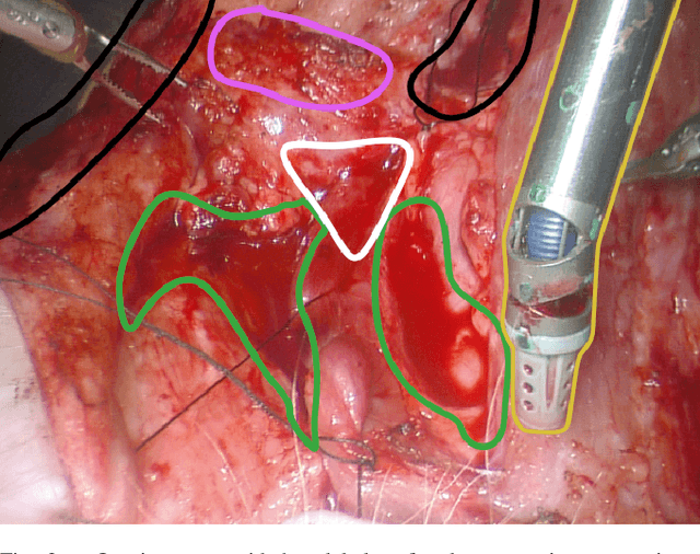 Figure 3 for HemoSet: The First Blood Segmentation Dataset for Automation of Hemostasis Management