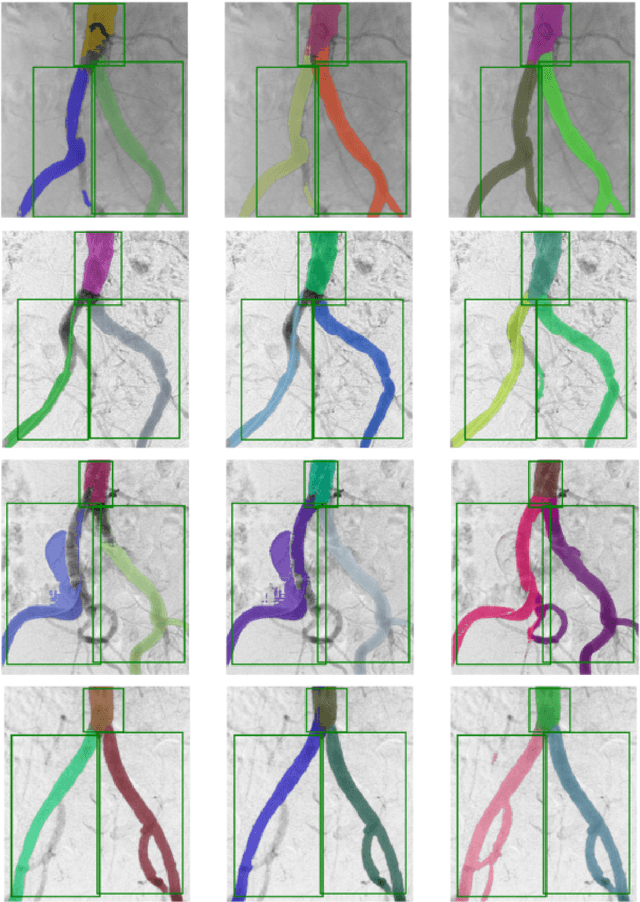 Figure 3 for Dr-SAM: An End-to-End Framework for Vascular Segmentation, Diameter Estimation, and Anomaly Detection on Angiography Images