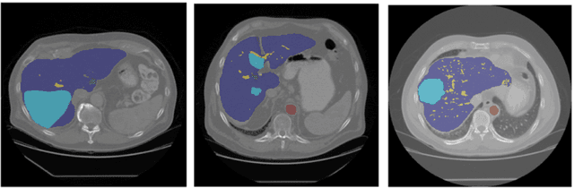 Figure 3 for A Holistic Weakly Supervised Approach for Liver Tumor Segmentation with Clinical Knowledge-Informed Label Smoothing