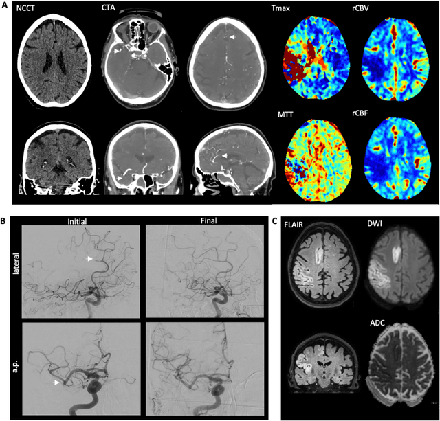 Figure 1 for ISLES 2024: The first longitudinal multimodal multi-center real-world dataset in (sub-)acute stroke