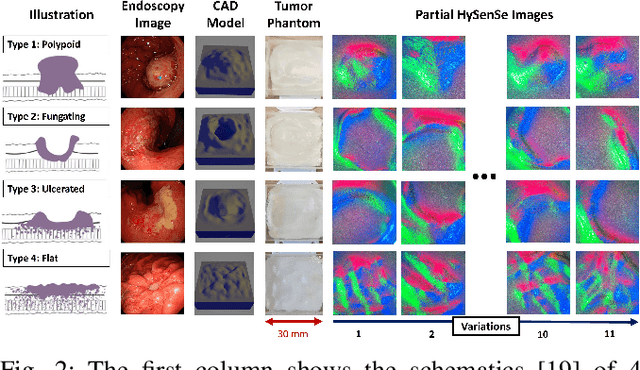 Figure 2 for Robot-Enabled Machine Learning-Based Diagnosis of Gastric Cancer Polyps Using Partial Surface Tactile Imaging