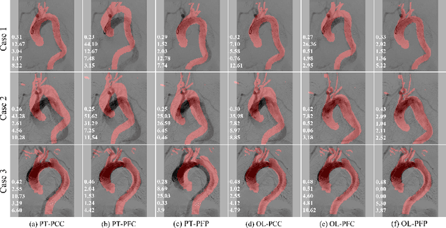 Figure 4 for UDCR: Unsupervised Aortic DSA/CTA Rigid Registration Using Deep Reinforcement Learning and Overlap Degree Calculation