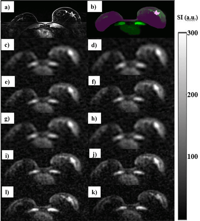 Figure 4 for Improved tissue sodium concentration quantification in breast cancer by reducing partial volume effects: a preliminary study