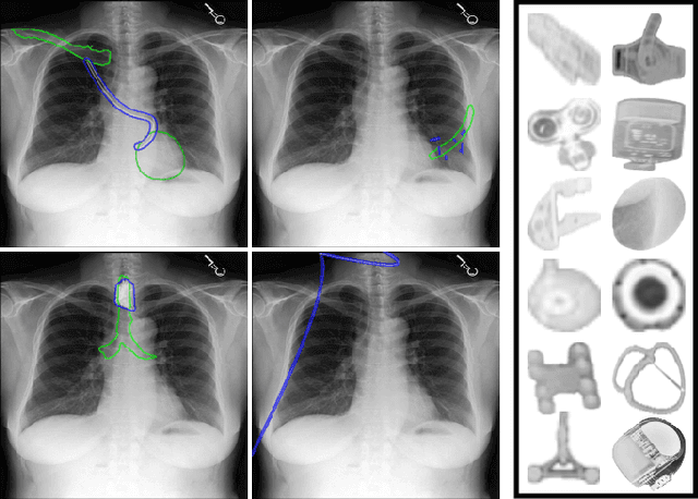 Figure 1 for Foreign object segmentation in chest x-rays through anatomy-guided shape insertion