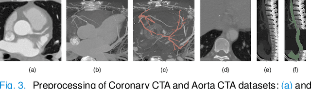 Figure 4 for 3D Vascular Segmentation Supervised by 2D Annotation of Maximum Intensity Projection