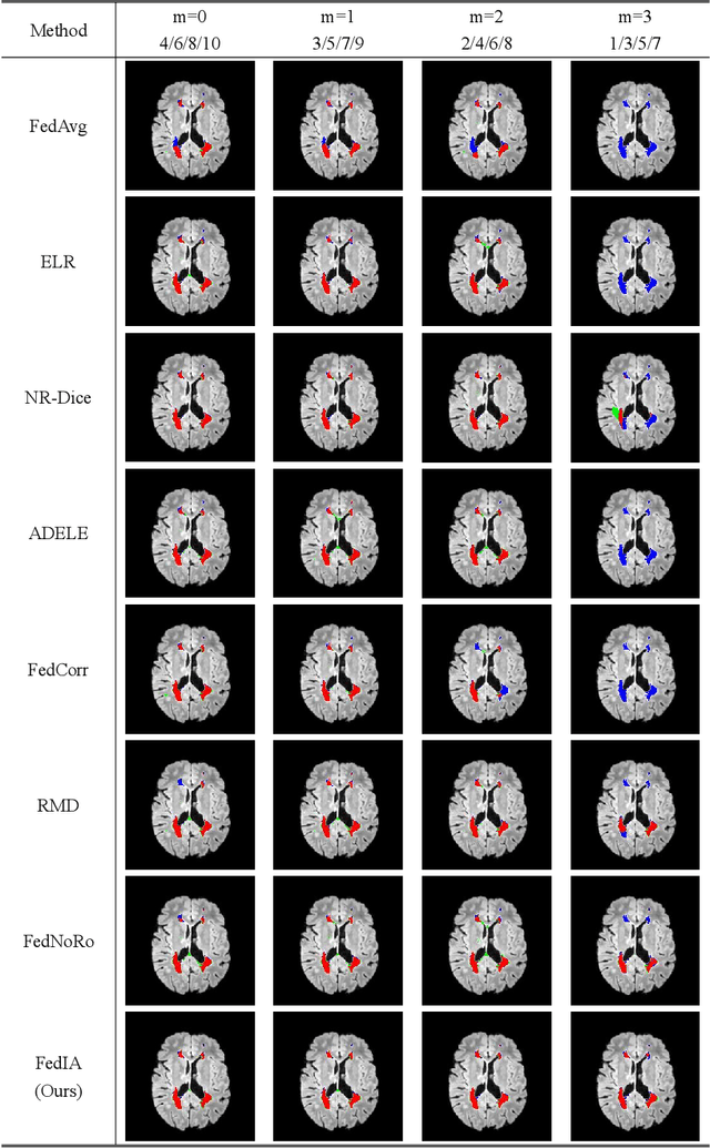 Figure 4 for FedIA: Federated Medical Image Segmentation with Heterogeneous Annotation Completeness