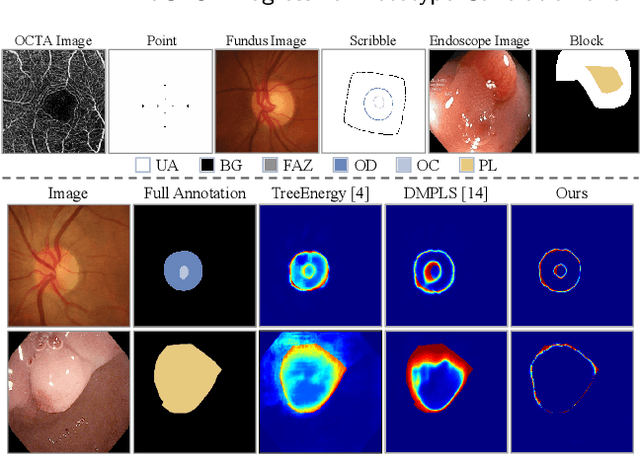 Figure 1 for ProCNS: Progressive Prototype Calibration and Noise Suppression for Weakly-Supervised Medical Image Segmentation