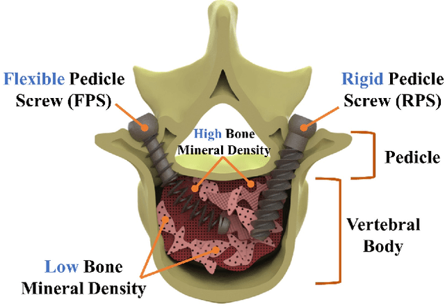 Figure 1 for Towards Biomechanical Evaluation of a Transformative Additively Manufactured Flexible Pedicle Screw for Robotic Spinal Fixation