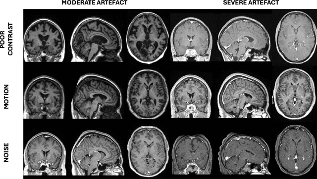 Figure 2 for Automated MRI Quality Assessment of Brain T1-weighted MRI in Clinical Data Warehouses: A Transfer Learning Approach Relying on Artefact Simulation