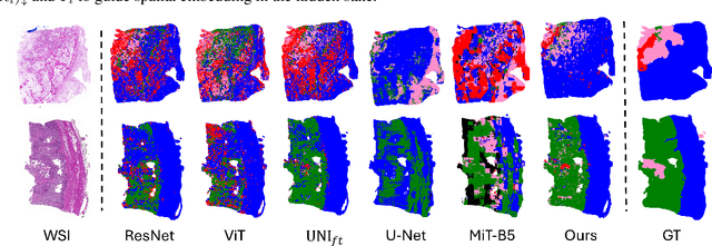 Figure 3 for Bridging Classification and Segmentation in Osteosarcoma Assessment via Foundation and Discrete Diffusion Models