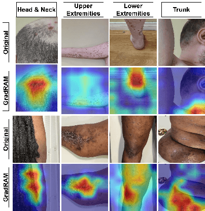 Figure 3 for PSO-Net: Development of an automated psoriasis assessment system using attention-based interpretable deep neural networks