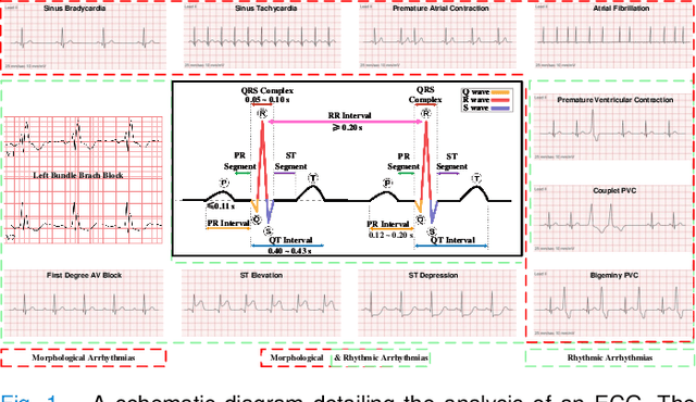 Figure 1 for ECG-CL: A Comprehensive Electrocardiogram Interpretation Method Based on Continual Learning