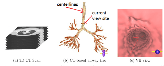 Figure 1 for Bronchoscopic video synchronization for interactive multimodal inspection of bronchial lesions