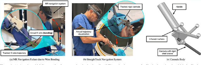 Figure 1 for StraightTrack: Towards Mixed Reality Navigation System for Percutaneous K-wire Insertion