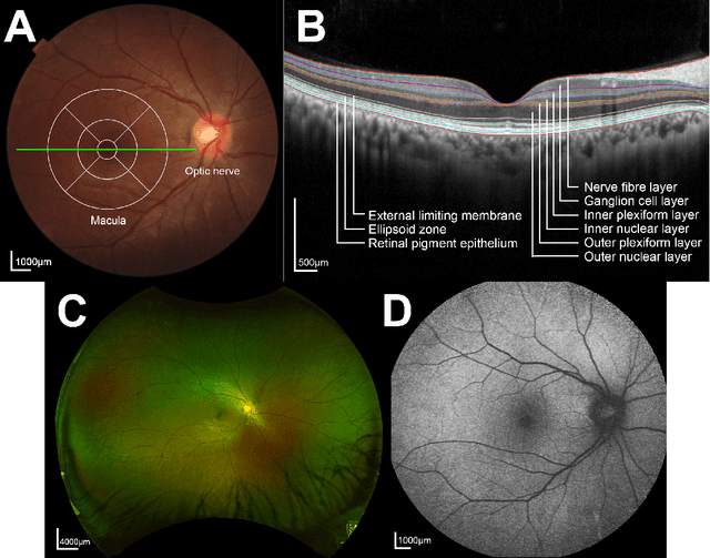 Figure 1 for Artificial intelligence techniques in inherited retinal diseases: A review