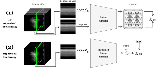 Figure 1 for Exploring the Utility of Self-Supervised Pretraining Strategies for the Detection of Absent Lung Sliding in M-Mode Lung Ultrasound