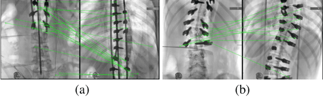 Figure 1 for SX-Stitch: An Efficient VMS-UNet Based Framework for Intraoperative Scoliosis X-Ray Image Stitching