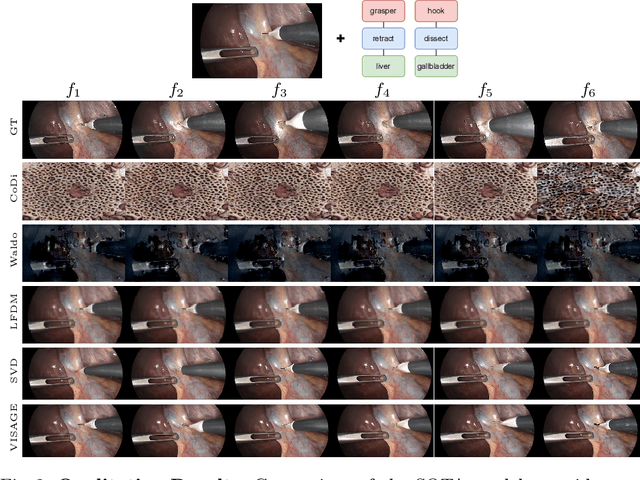 Figure 4 for VISAGE: Video Synthesis using Action Graphs for Surgery