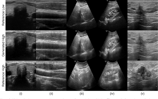 Figure 3 for Ultrasound Image Enhancement using CycleGAN and Perceptual Loss