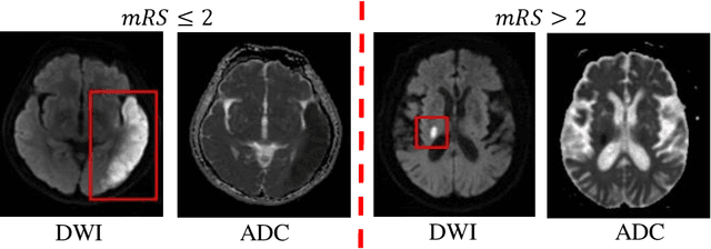 Figure 1 for Fusion of Diffusion Weighted MRI and Clinical Data for Predicting Functional Outcome after Acute Ischemic Stroke with Deep Contrastive Learning