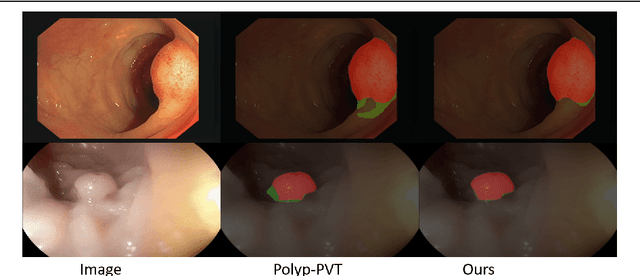 Figure 1 for SegT: A Novel Separated Edge-guidance Transformer Network for Polyp Segmentation