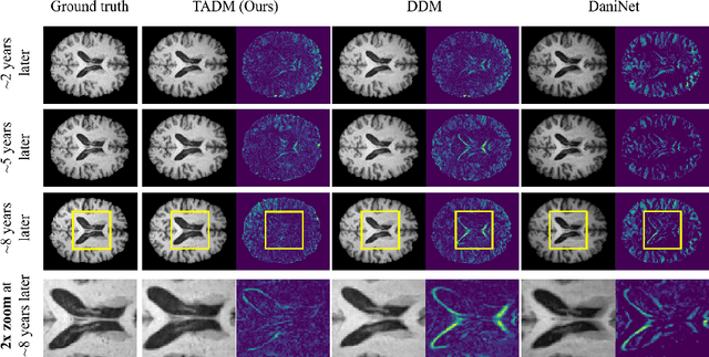 Figure 4 for TADM: Temporally-Aware Diffusion Model for Neurodegenerative Progression on Brain MRI