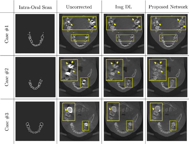 Figure 2 for Metal Artifact Reduction with Intra-Oral Scan Data for 3D Low Dose Maxillofacial CBCT Modeling