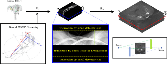 Figure 1 for Metal Artifact Reduction with Intra-Oral Scan Data for 3D Low Dose Maxillofacial CBCT Modeling