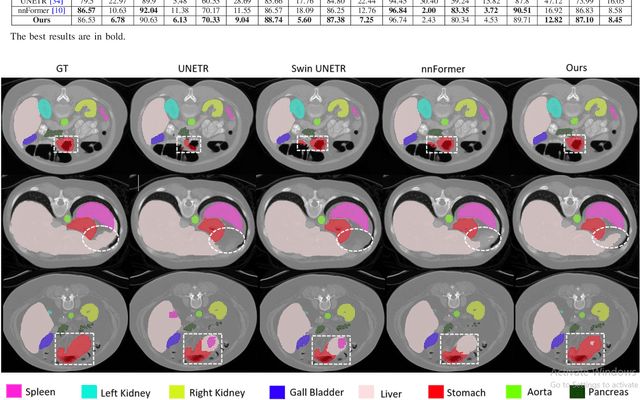 Figure 2 for Improving 3D Medical Image Segmentation at Boundary Regions using Local Self-attention and Global Volume Mixing