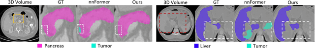 Figure 3 for Improving 3D Medical Image Segmentation at Boundary Regions using Local Self-attention and Global Volume Mixing