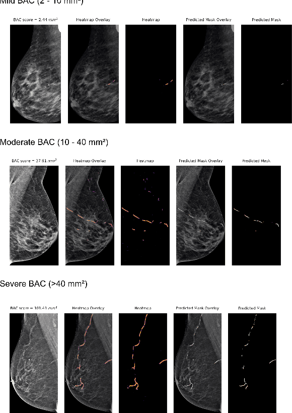 Figure 1 for Novel AI-Based Quantification of Breast Arterial Calcification to Predict Cardiovascular Risk