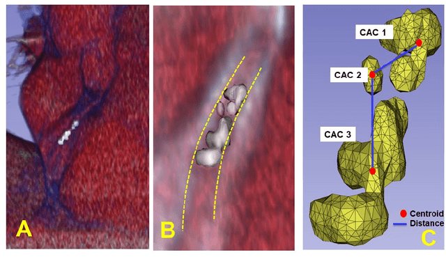 Figure 3 for Enhancing cardiovascular risk prediction through AI-enabled calcium-omics