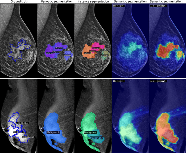 Figure 3 for Panoptic Segmentation of Mammograms with Text-To-Image Diffusion Model