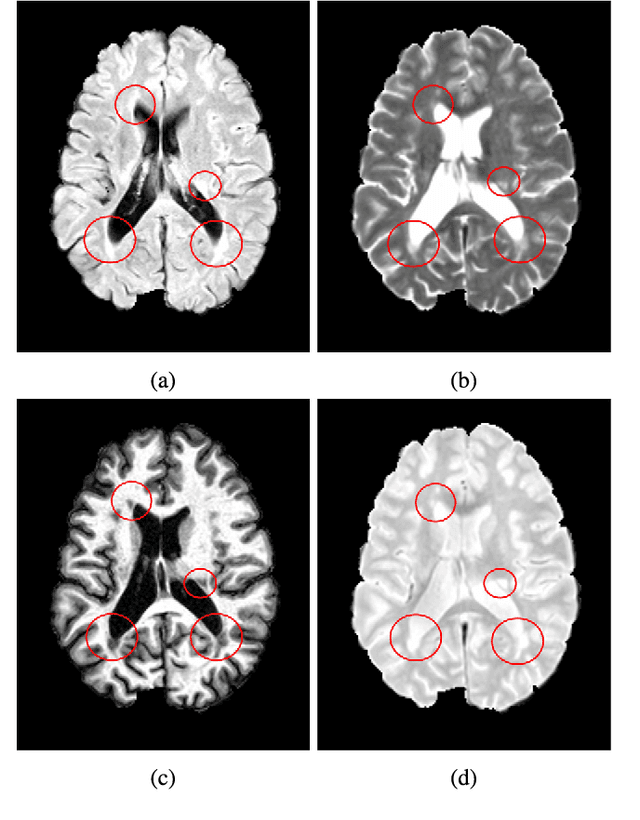 Figure 1 for Boosting multiple sclerosis lesion segmentation through attention mechanism